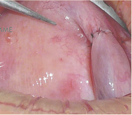 Clínica de Laparoscopía Ginecológica - Tijuana Gynecologist/Ginecología Tijuana, Dr. Daniel Sánchez, ginecólogos, laparoscopy, infertilidad, infertility, gynecology