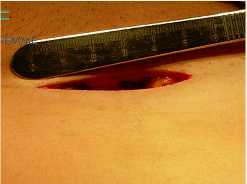 Clínica de Laparoscopía Ginecológica - Tijuana Gynecologist/Ginecología Tijuana, Dr. Daniel Sánchez, ginecólogos, laparoscopy, infertilidad, infertility, gynecology