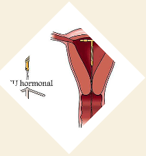Clínica de Laparoscopía Ginecológica - Tijuana Ginecologist/Ginecologia Tijuana, Dr. Daniel Sánchez, ginecologos, laparoscopy, infertilidad, infertility, ginecology