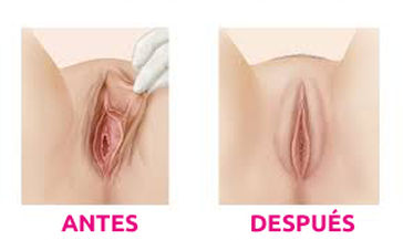 vaginoplastia