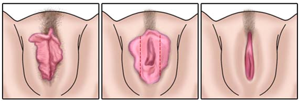 vaginoplastia1