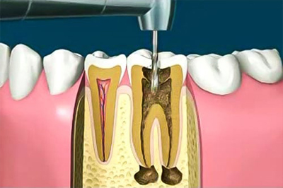 Endodoncia