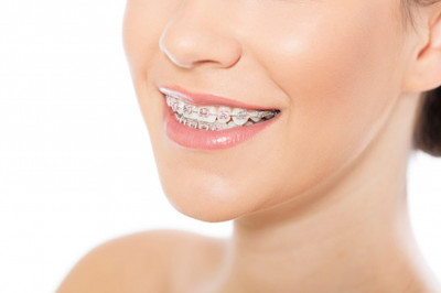Ortodoncia Brackets